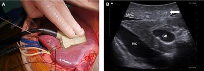 Identification of resection plane for anatomical liver resection using ultrasonography-guided needle insertion
